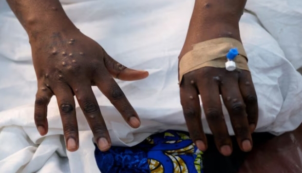 TWO DEAD AS MPOX HITS NYALI AND CHANGAMWE