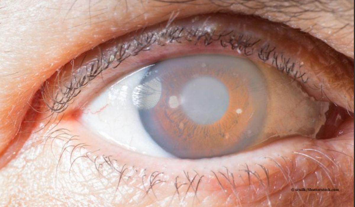 January is Glaucoma Awareness Month: Protect Your Vision Before It’s Too Late