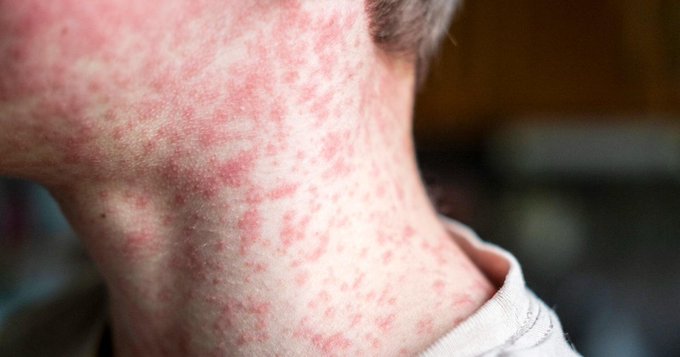 139 Unvaccinated Students Quarantined After Measles Exposure in South Carolina